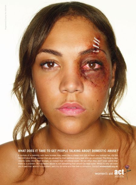 Domestic Violence Bruises